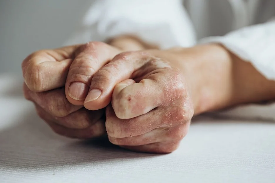 BMS’ Sotyktu Receives FDA Expansion in Psoriatic Arthritis