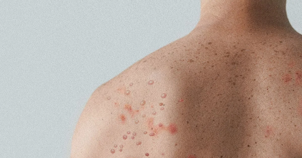 Measles Is on the Rise. Have You Reviewed Your Vaccine Policies Since Covid?