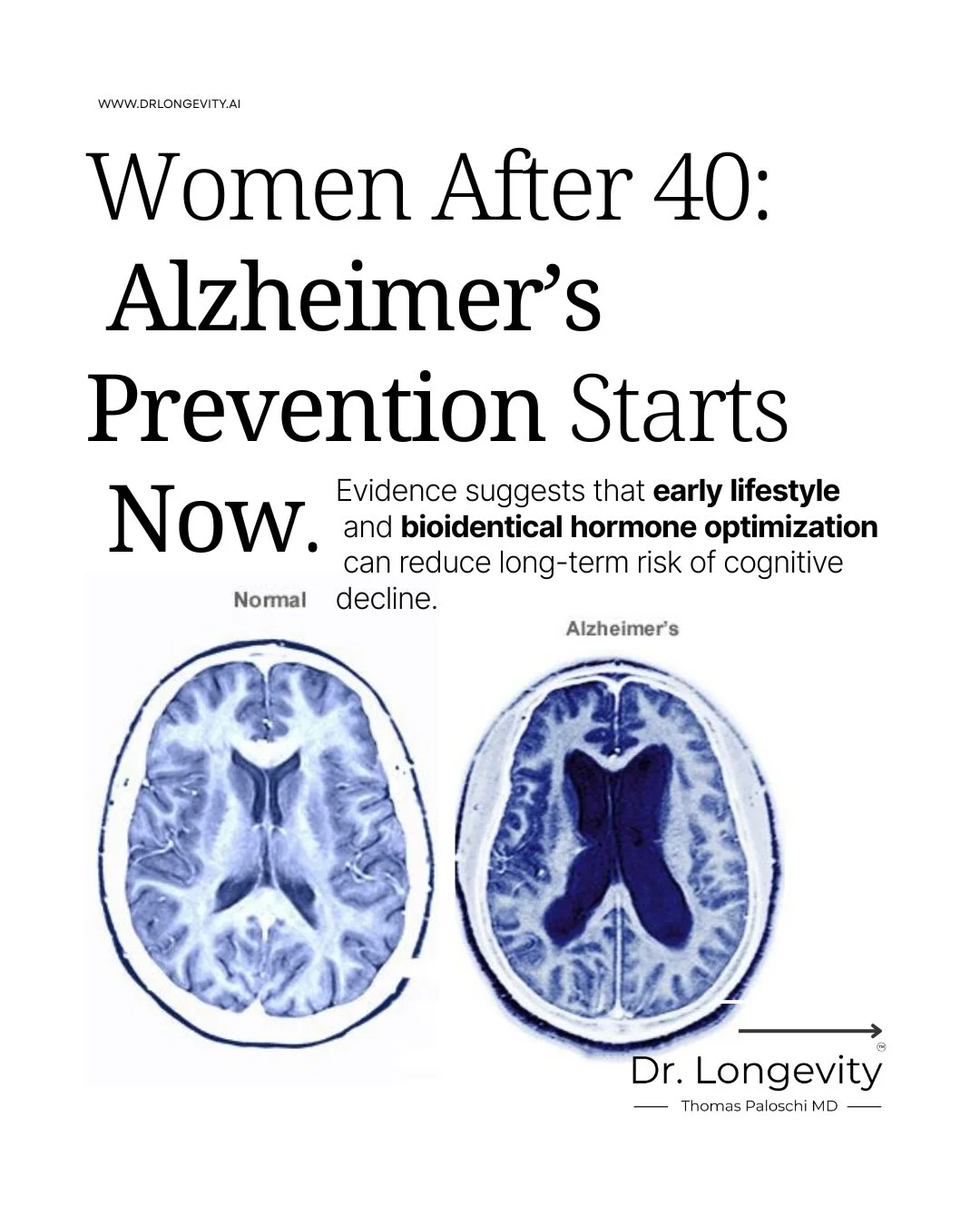 Alzheimer’s Prevention Begins Decades Early with Hormones, Sleep, Muscle