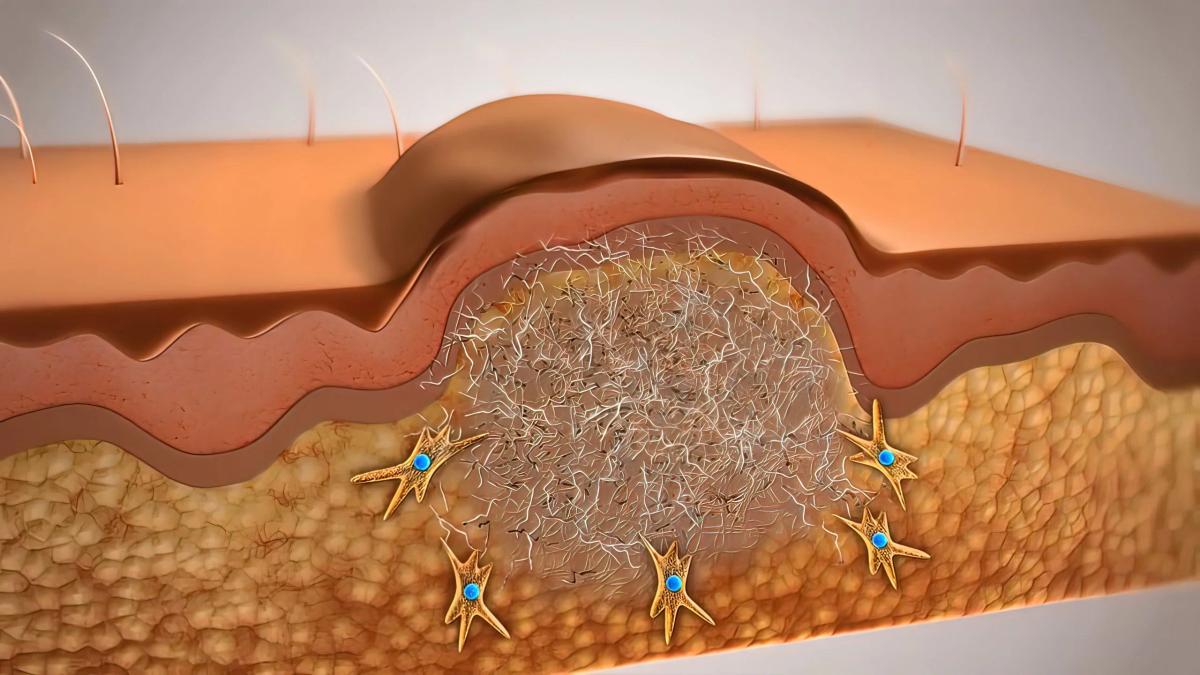 Skin Regeneration Enabled by Embryonic Healing Mechanism in Mice