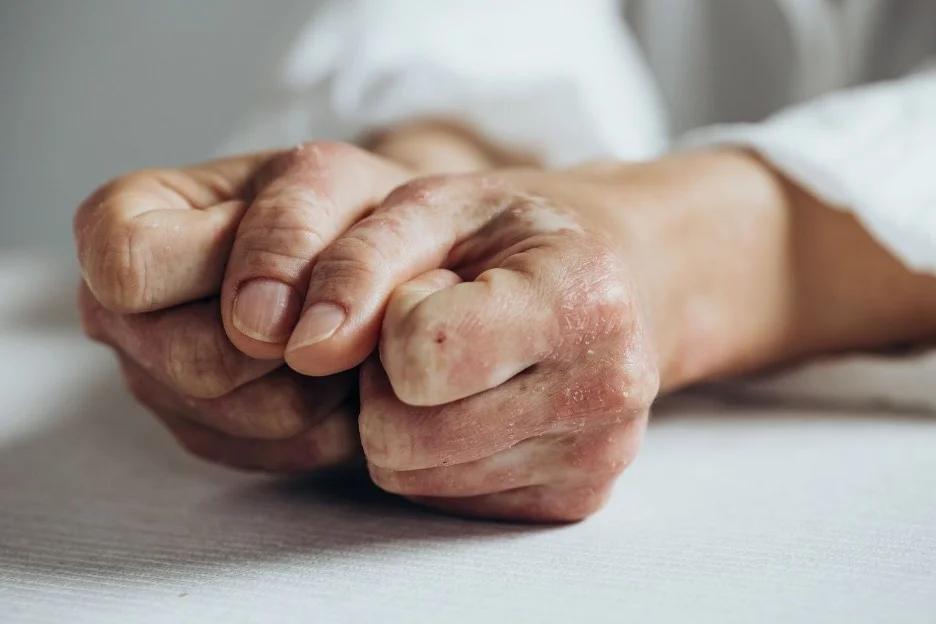 BMS’ Sotyktu Receives FDA Expansion in Psoriatic Arthritis