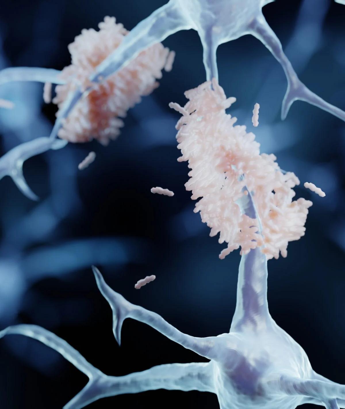 Anti-Epileptic Drug May Prevent Early Plaque Formation in Alzheimer’s Disease