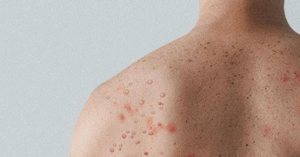 Measles Is on the Rise. Have You Reviewed Your Vaccine Policies Since Covid?