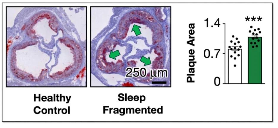 Sleep Deprivation Triggers Hormone That Fuels Heart Disease