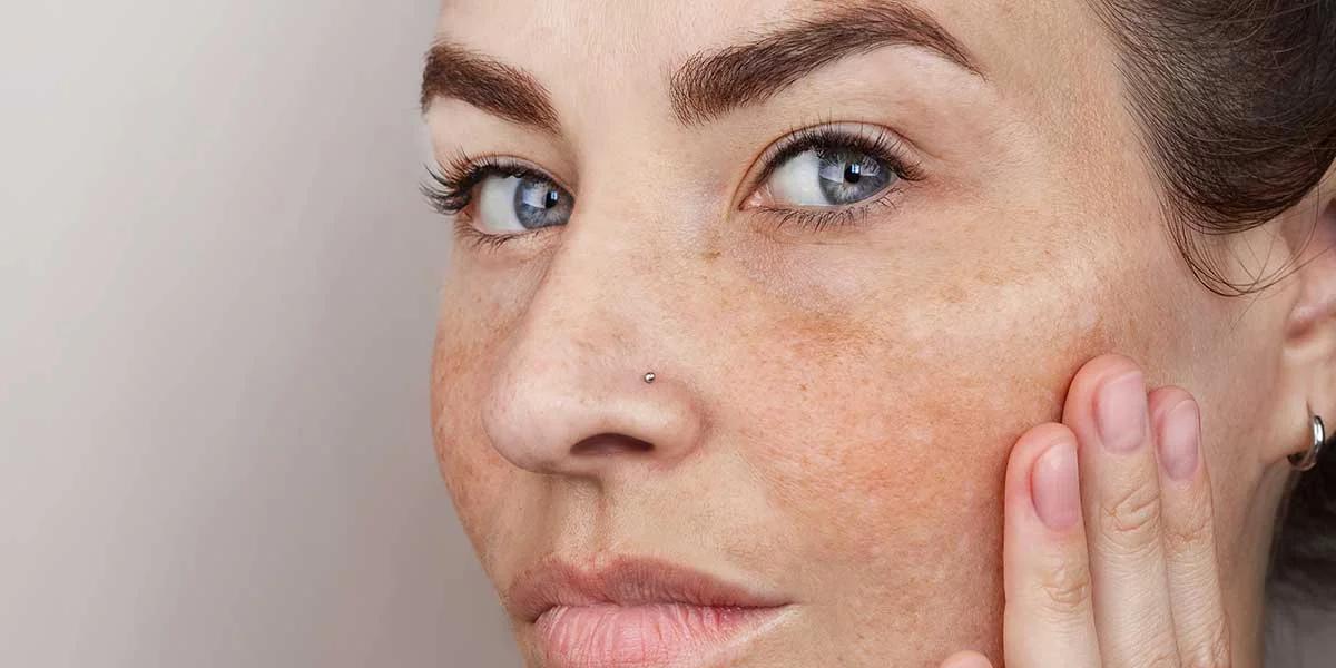 Age Spots Linked to Epigenetic Drift, Potentially Reversible