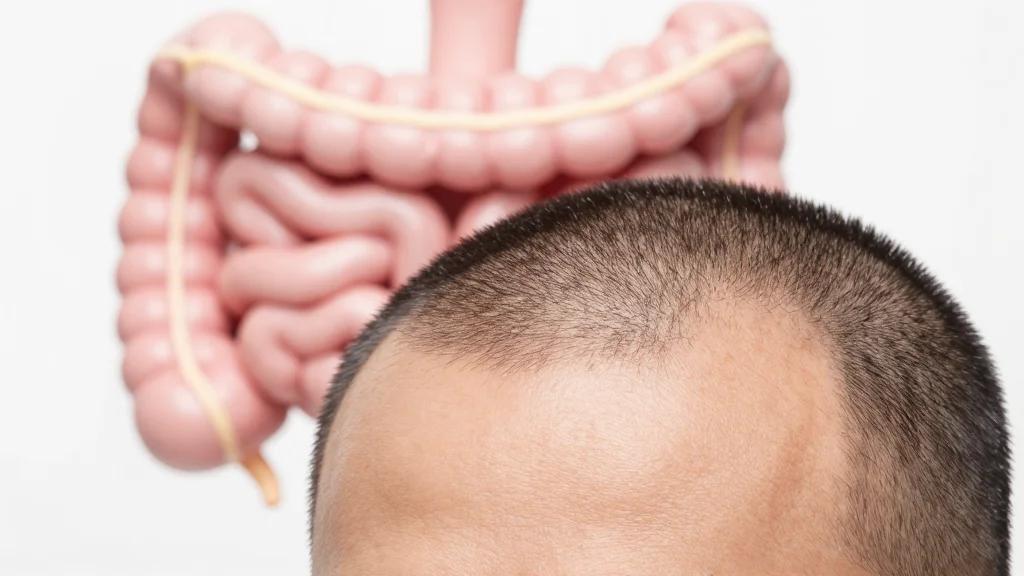 Noteworthy Studies on JAK Inhibitors, Skin-Gut Relationship in Alopecia Areata: Maria Hordinsky, MD